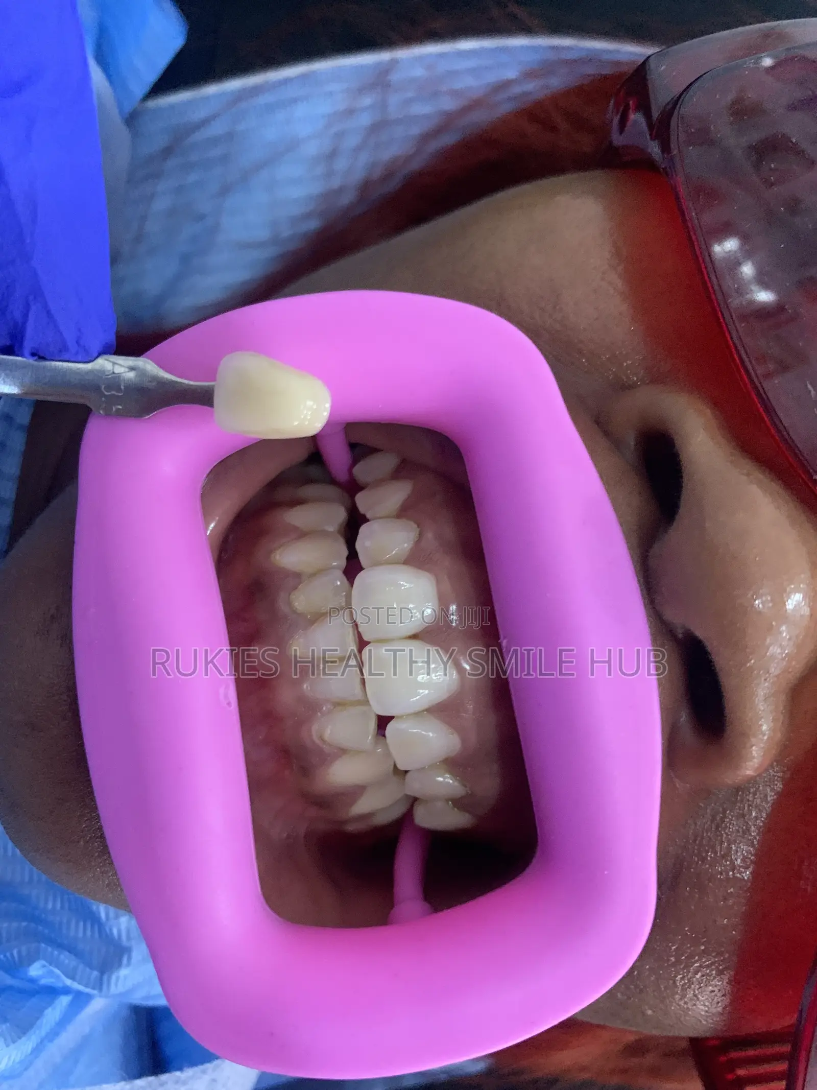 Basic Teeth Whitening