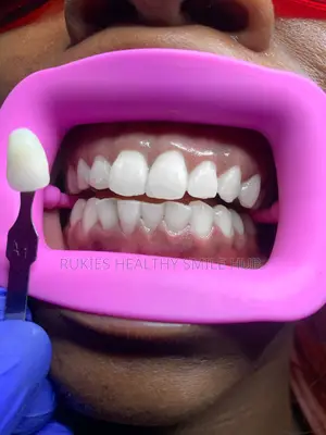 Basic Teeth Whitening