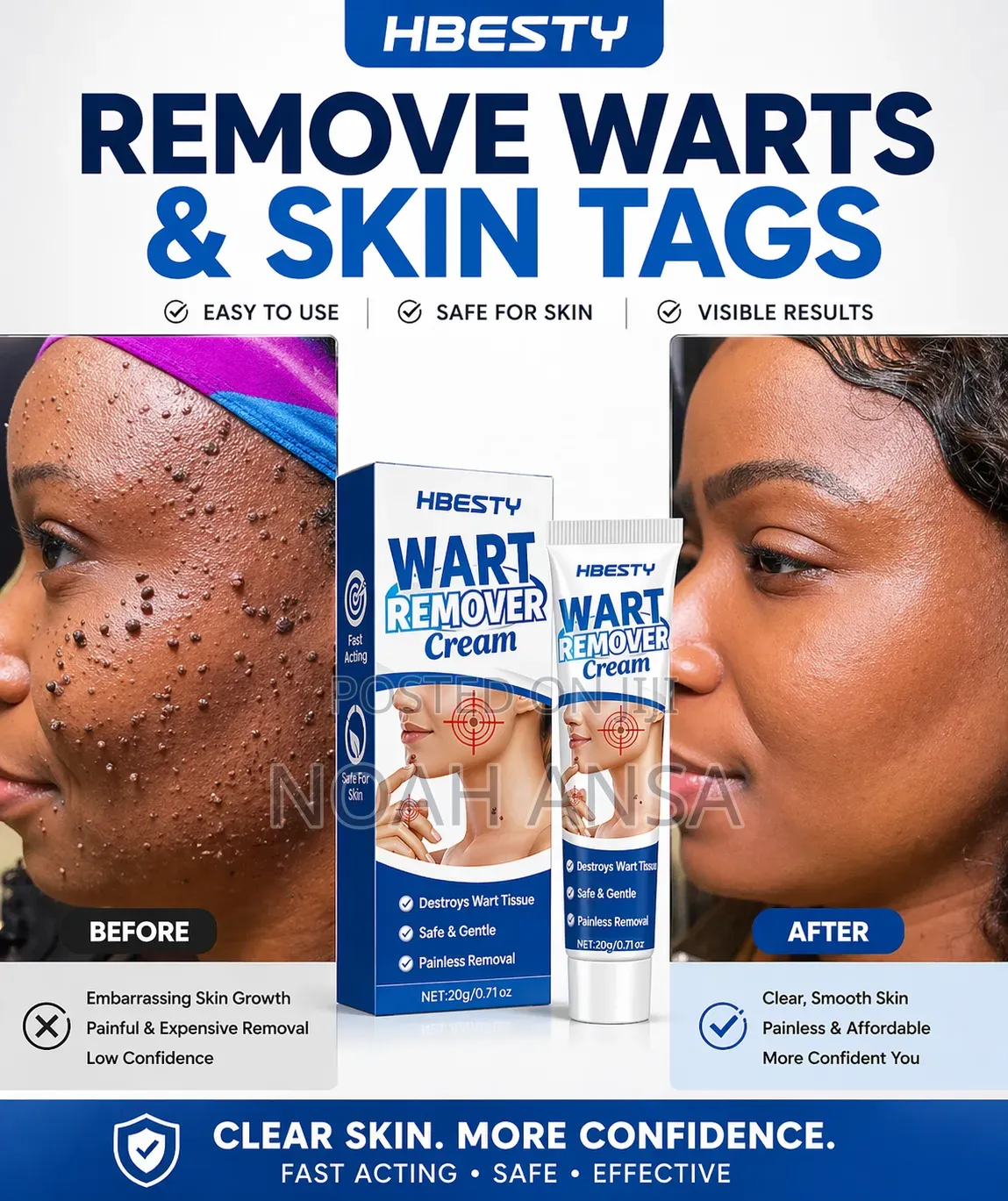 Hbesty Wart Remover Cream