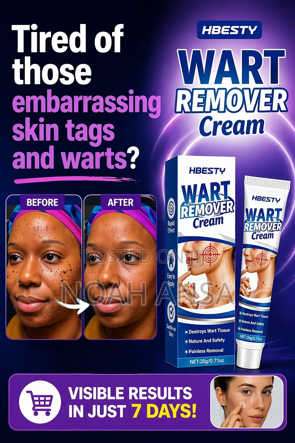 Hbesty Wart Remover Cream