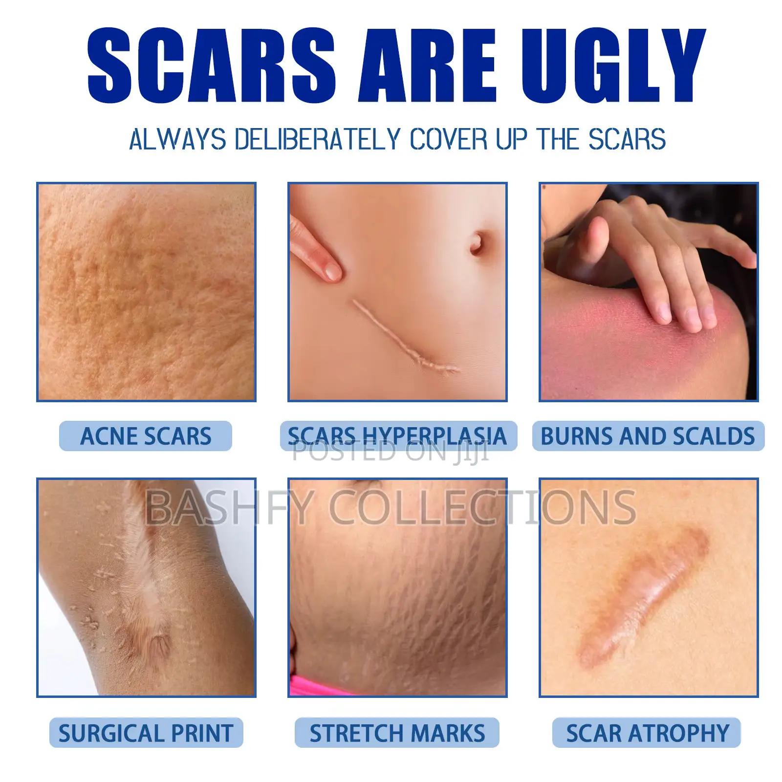 Scar Removal Cream