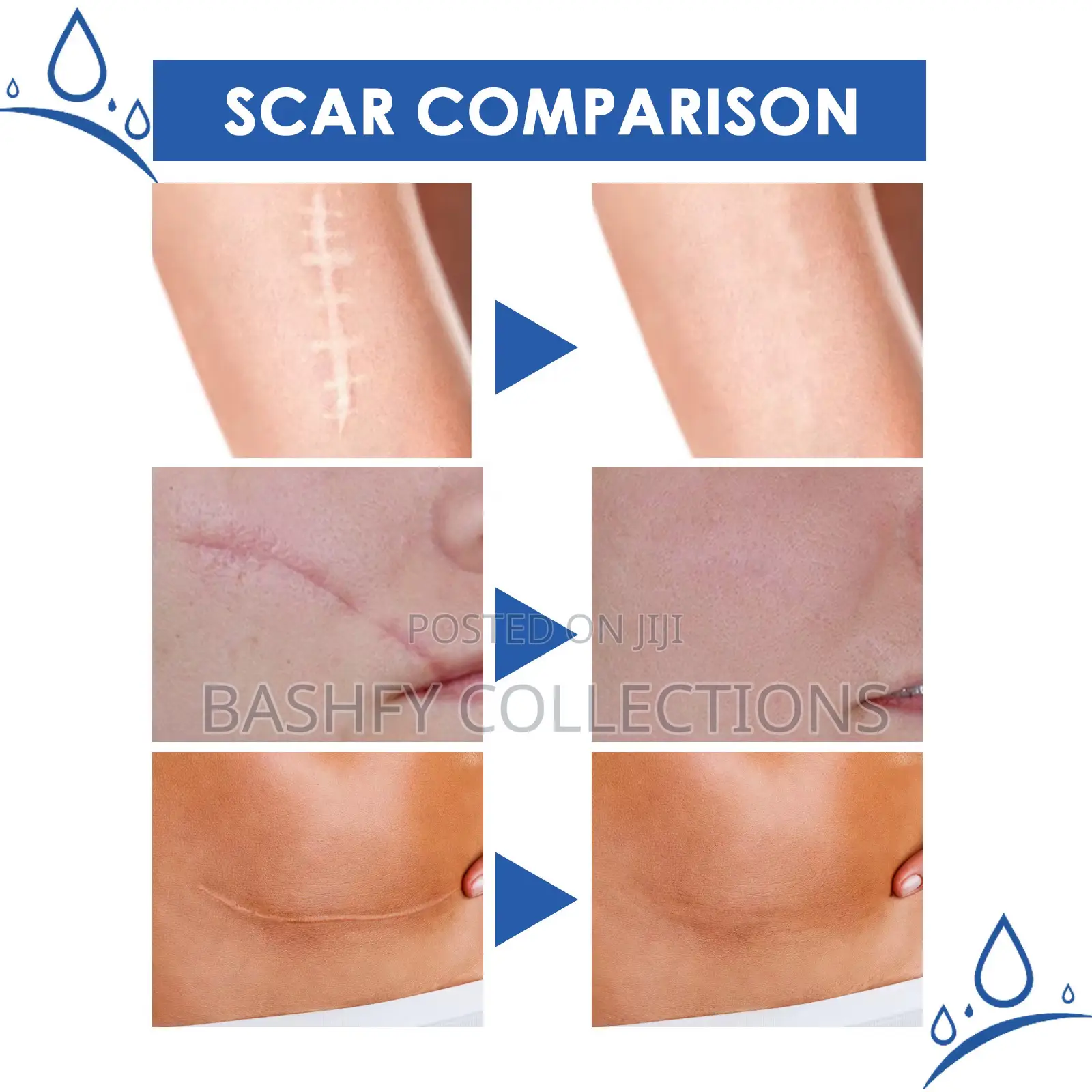 Scar Removal Cream