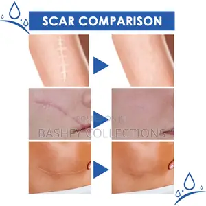 Scar Removal Cream