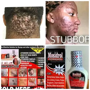 Mosidrol Herbal Acne Lotion
