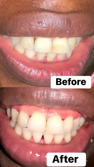 Teeth Cleaning