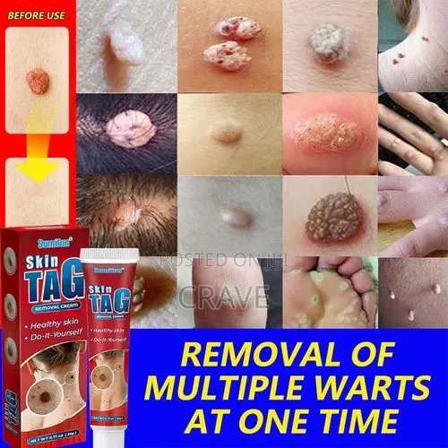 Sumifun Skin Tag Removal Cream