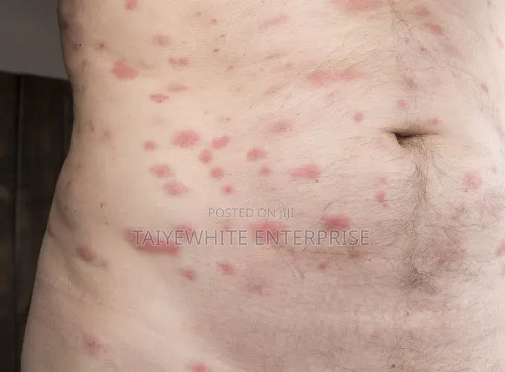 Bedbug Treatment Fumigation Service | Same Day Inspection