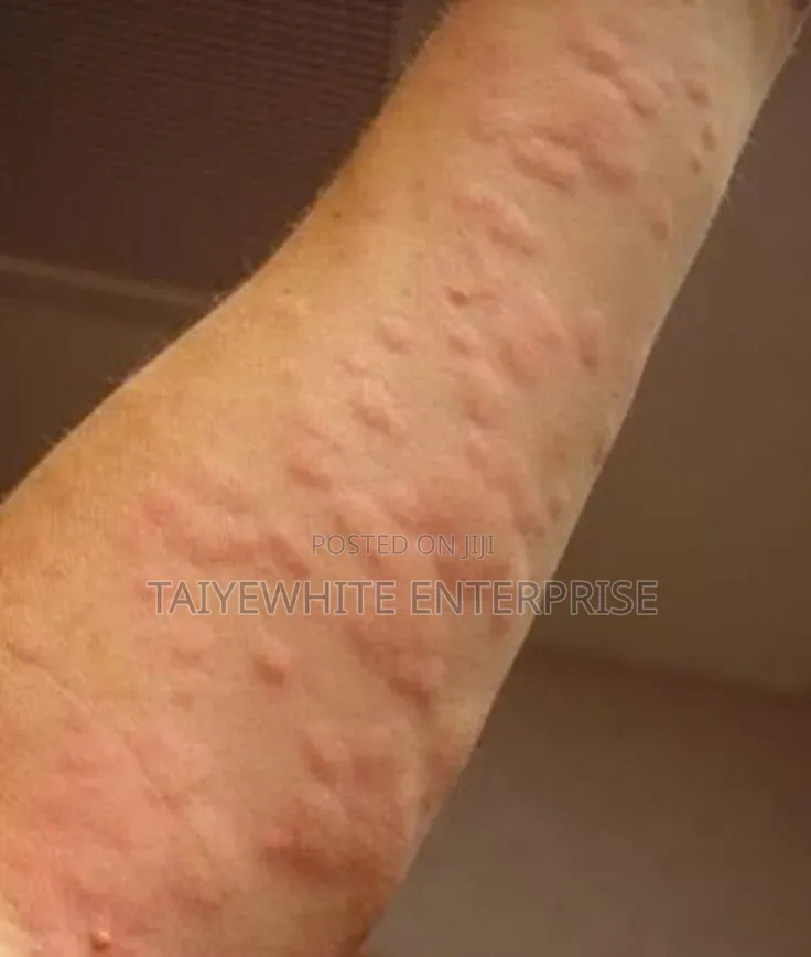Bedbug Treatment Fumigation Service | Same Day Inspection