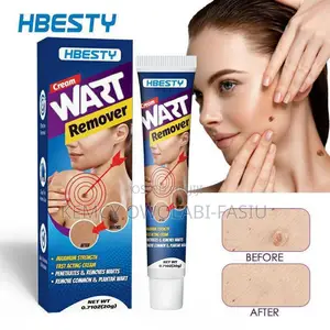 Wart Remover Onitment