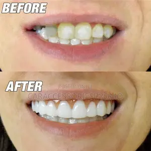Perfect Smile Veneers