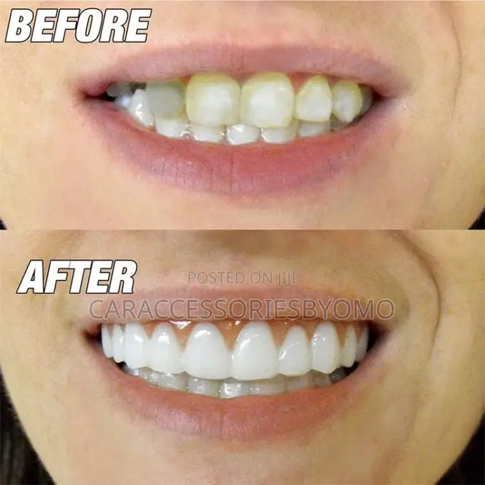 Perfect Smile Veneers