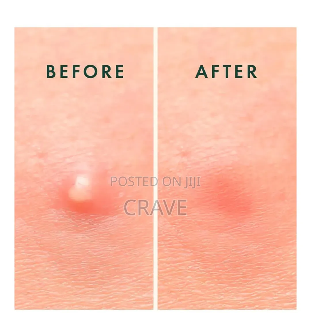 Kormesic Pustular Acne Patches (36)