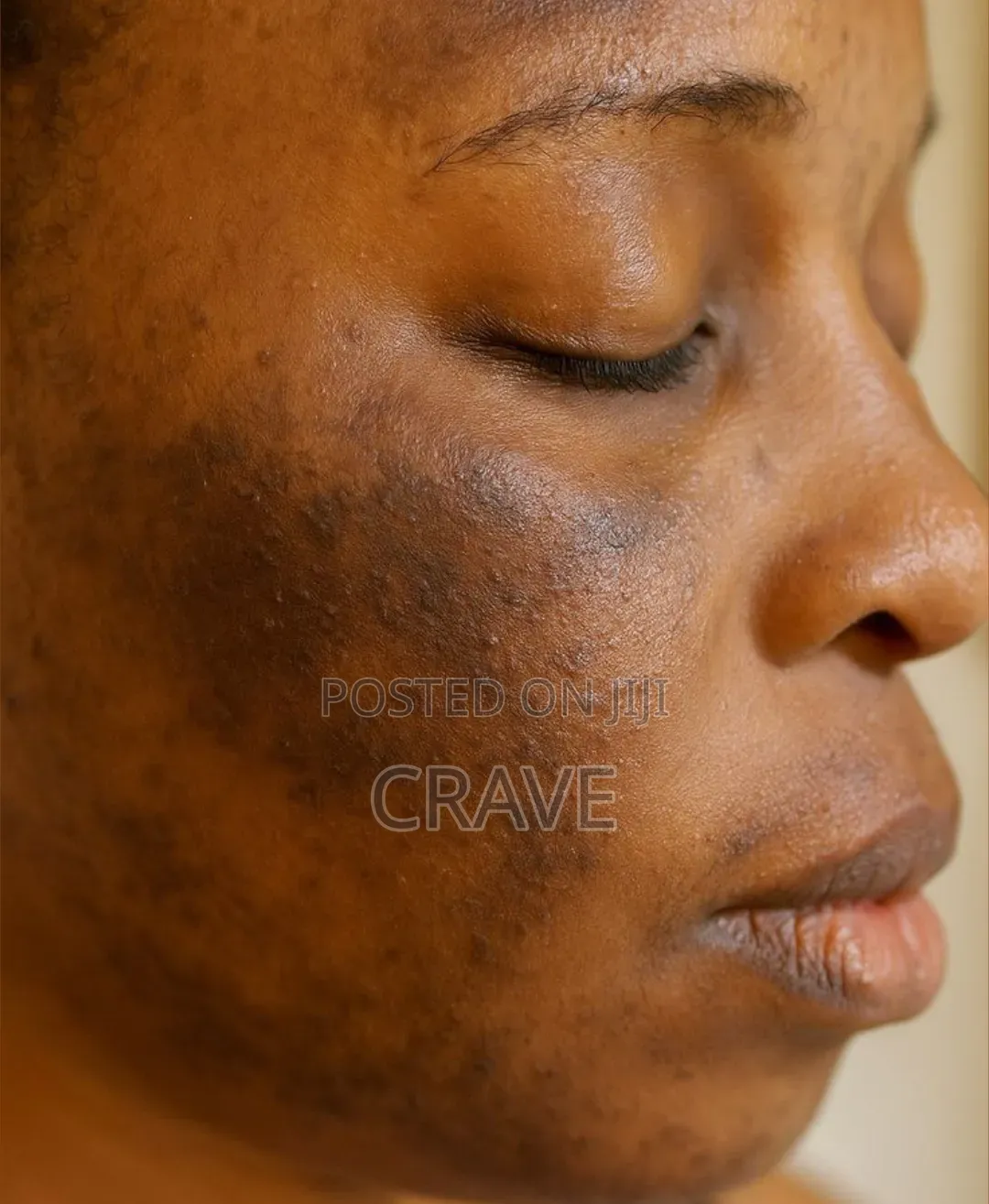 KORMESIC Multi-Action Cream for Pimples, Hyperpigmentation&Uneven Skin