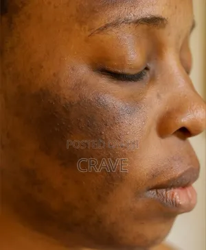KORMESIC Multi-Action Cream for Pimples, Hyperpigmentation&Uneven Skin