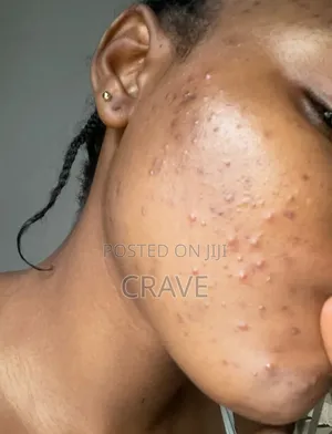 KORMESIC Multi-Action Cream for Pimples, Hyperpigmentation&Uneven Skin