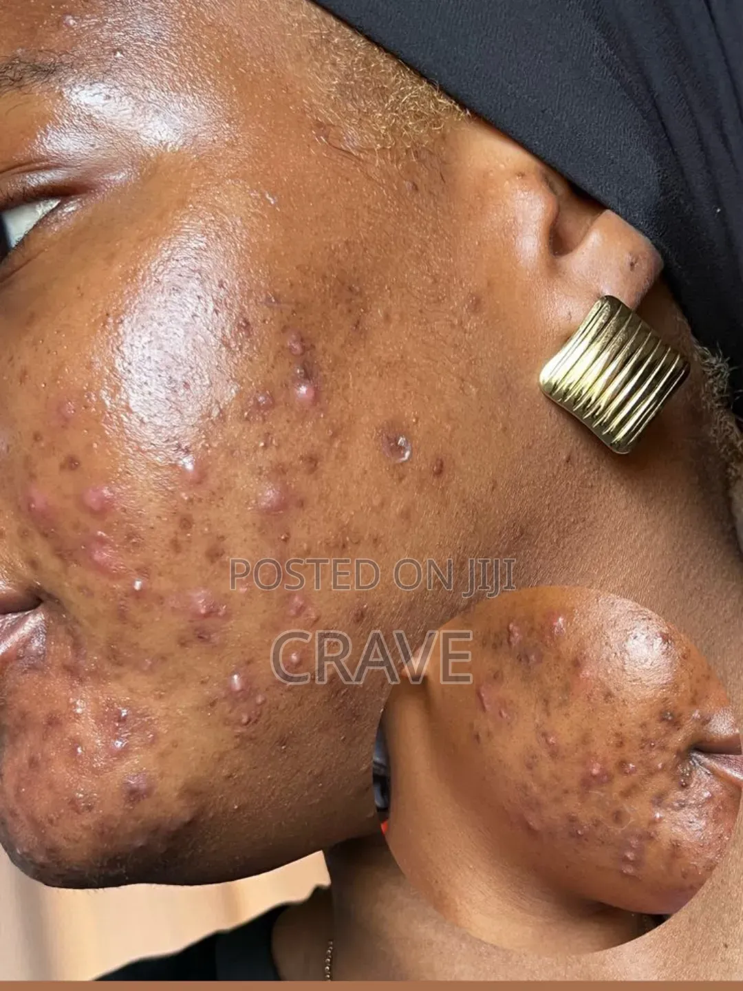 KORMESIC Multi-Action Cream for Pimples, Hyperpigmentation&Uneven Skin