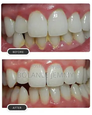 Scaling and Polishing