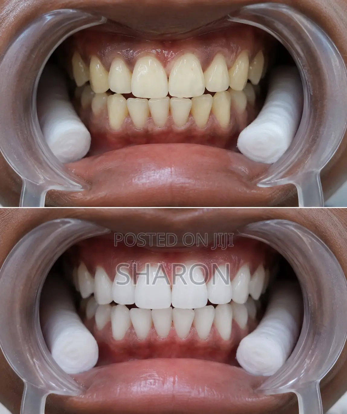 Dental Procedure
