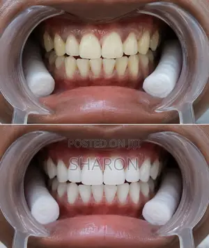 Dental Procedure