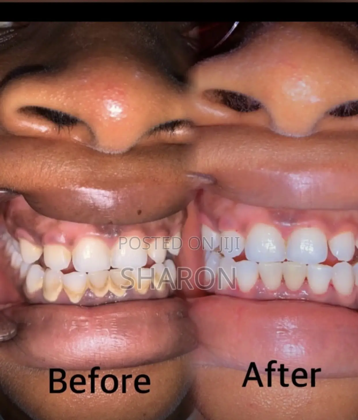 Dental Procedure