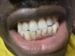 Teet Washing and Whitening