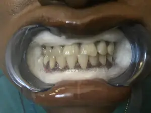 Professional Teeth Washing and Whitening