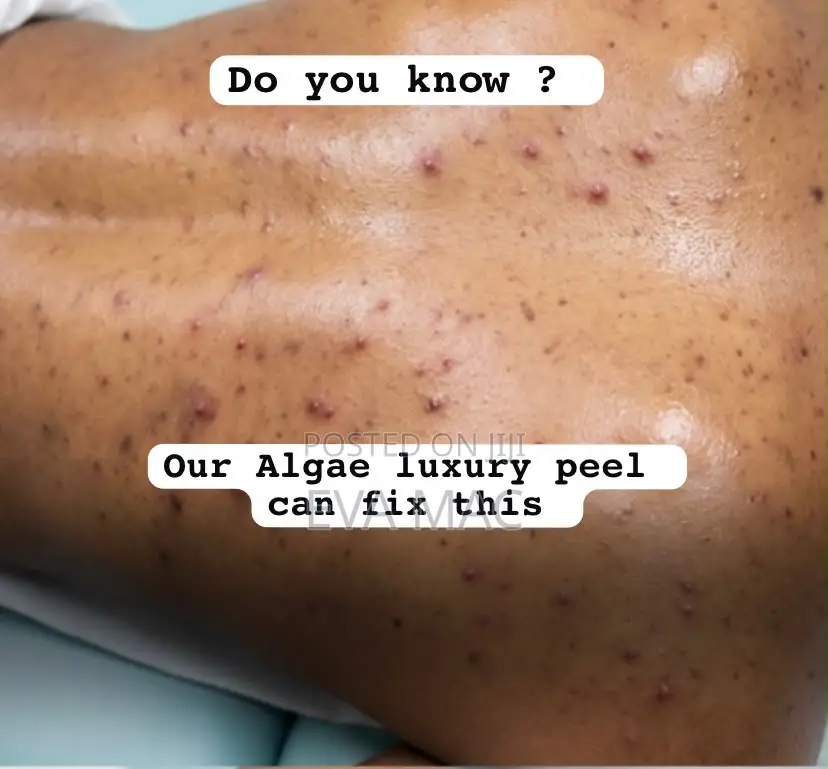 Algae Peel (Herbal Peel)
