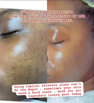 Algae Peel (Herbal Peel)