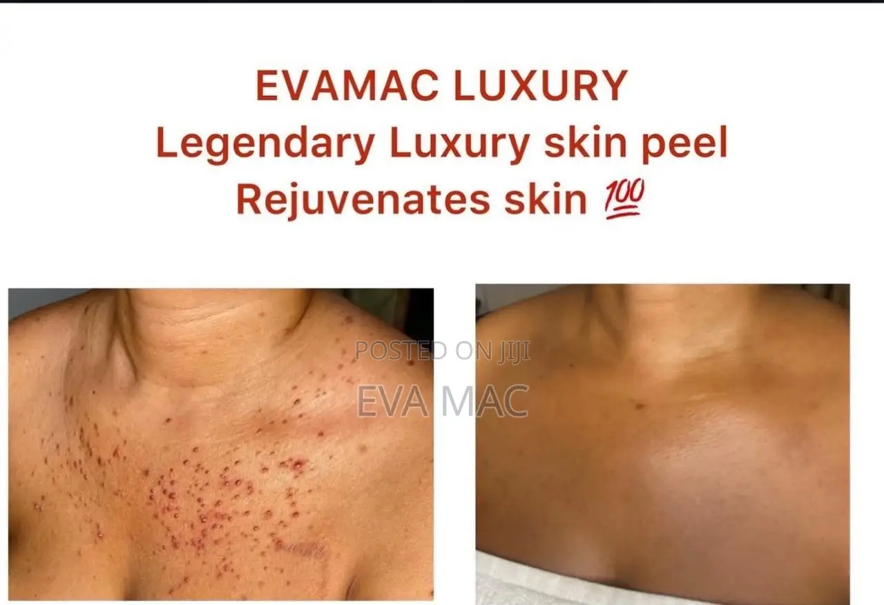 Algae Peel (Herbal Peel)