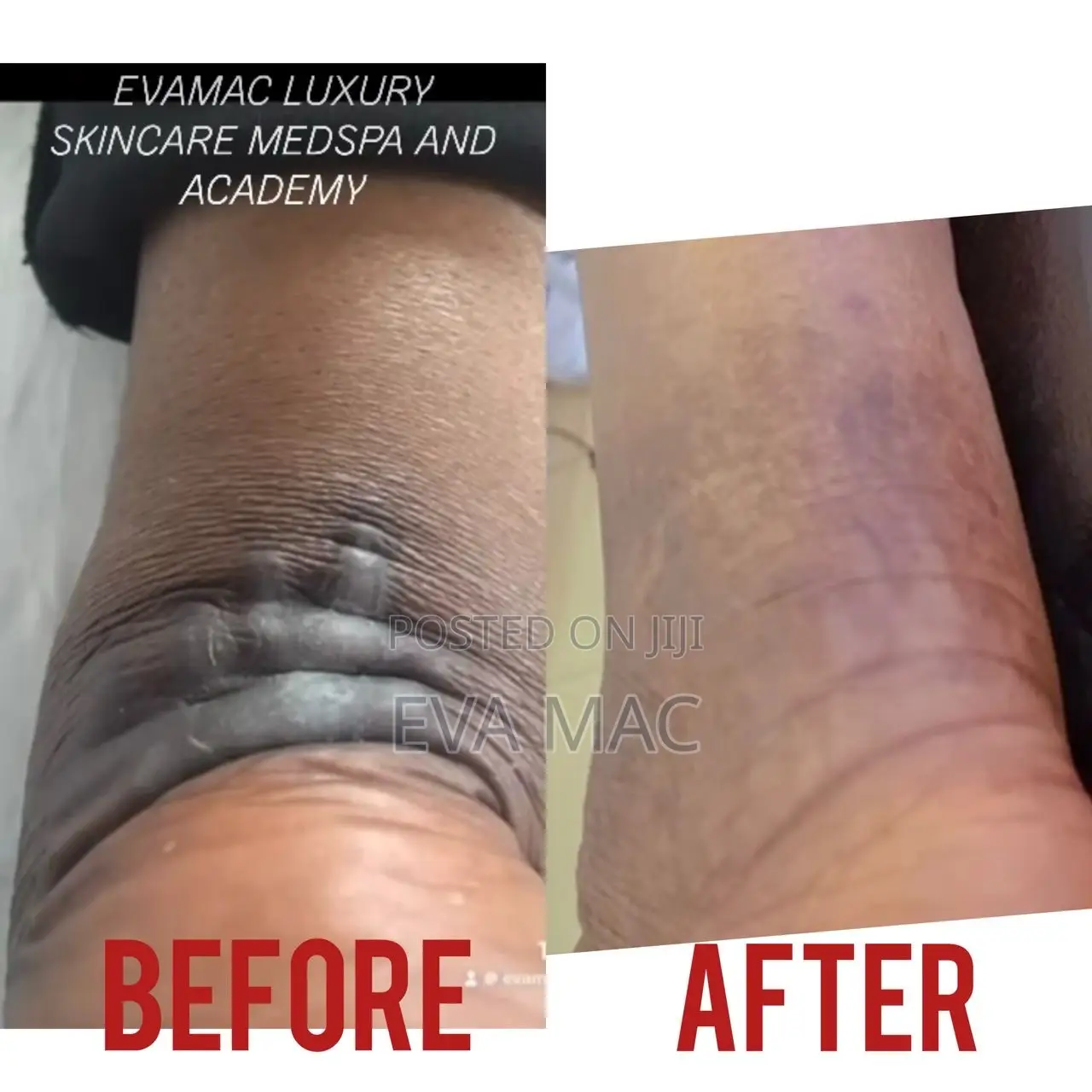 Algae Peel (Herbal Peel)