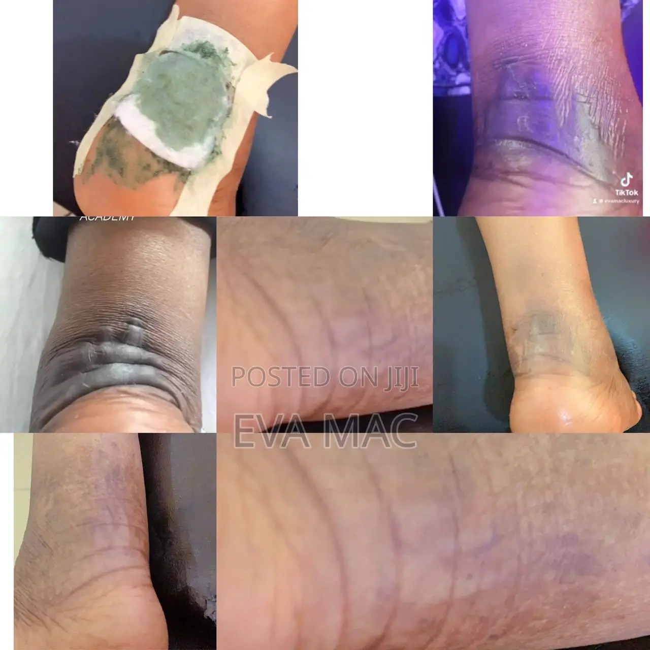 Algae Peel (Herbal Peel)