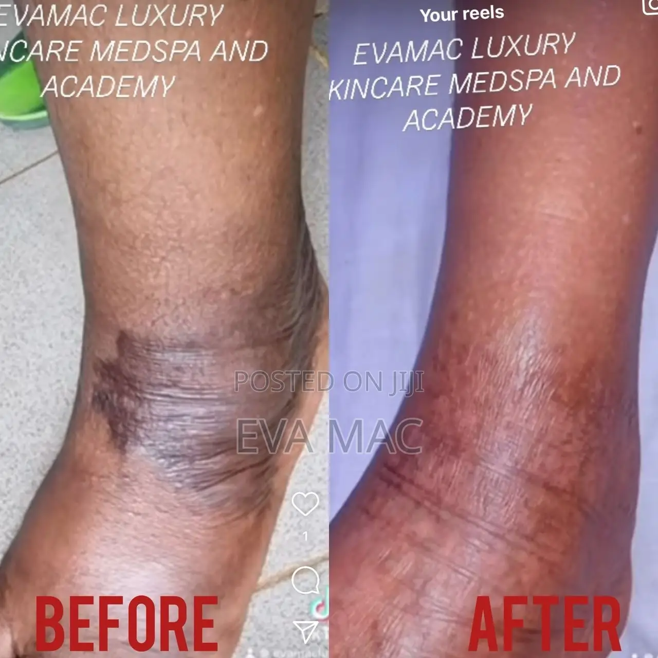 Algae Peel (Herbal Peel)