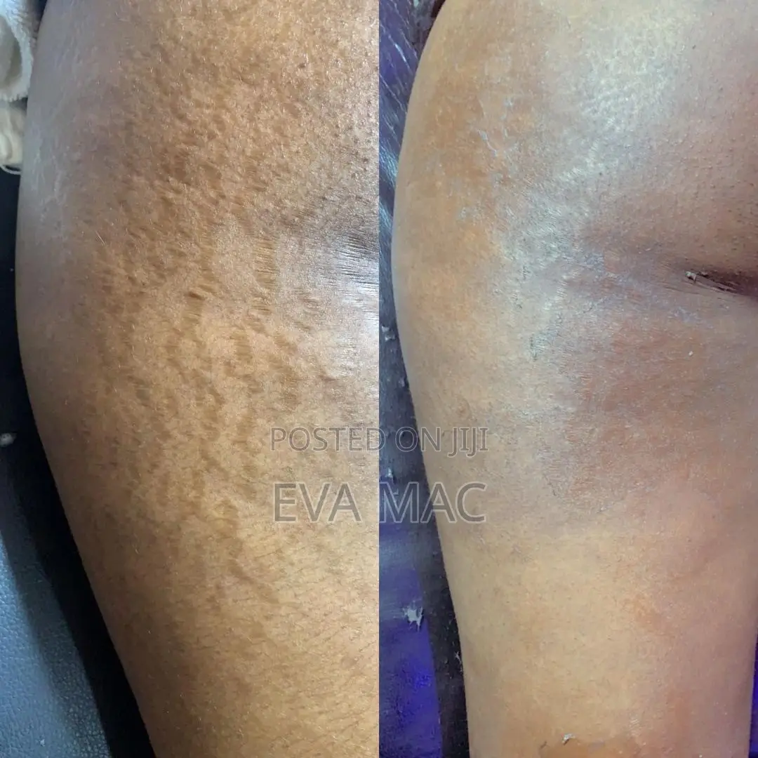 Algae Peel (Herbal Peel)