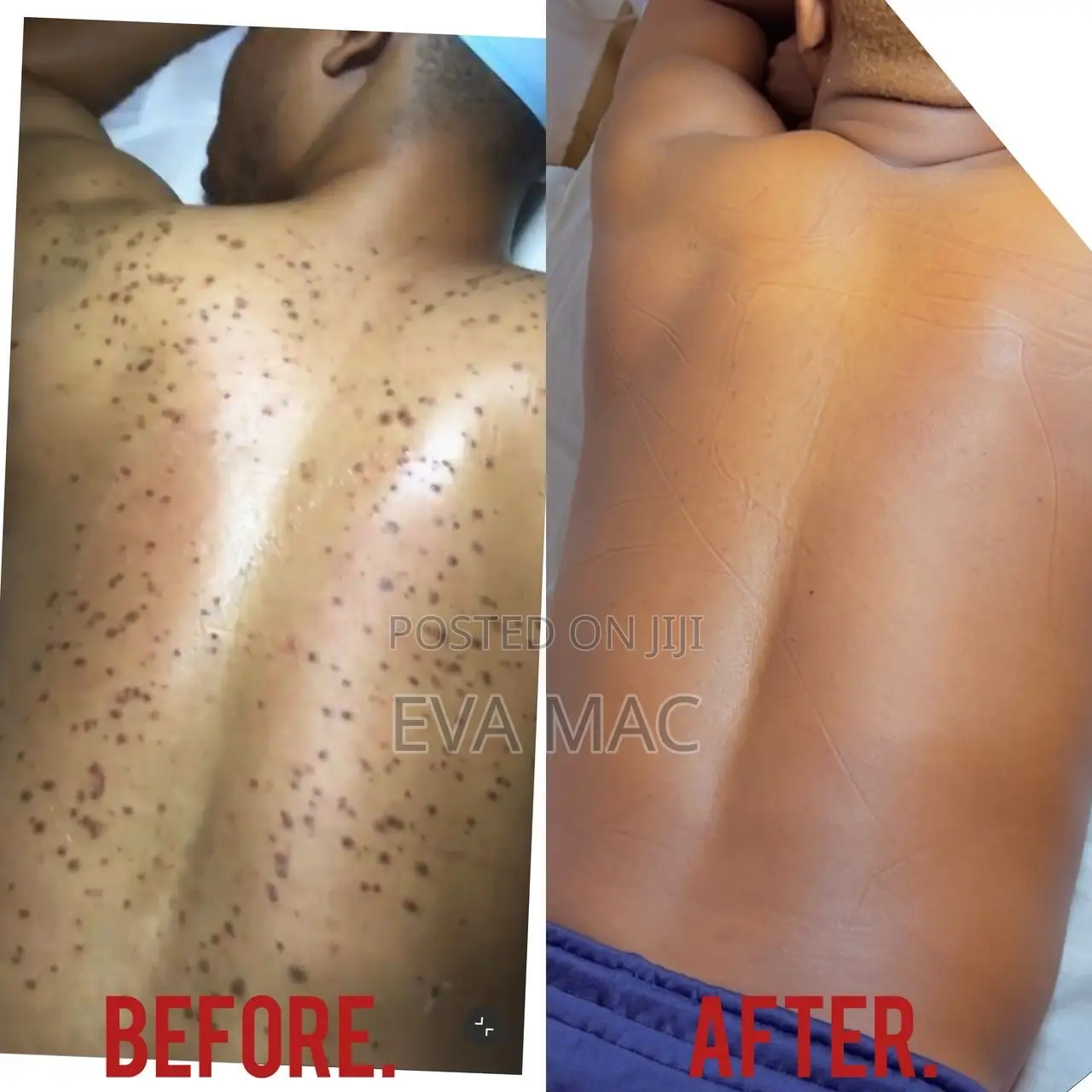 Algae Peel (Herbal Peel)