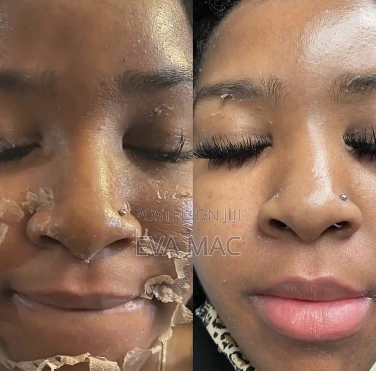 Algae Peel (Herbal Peel)