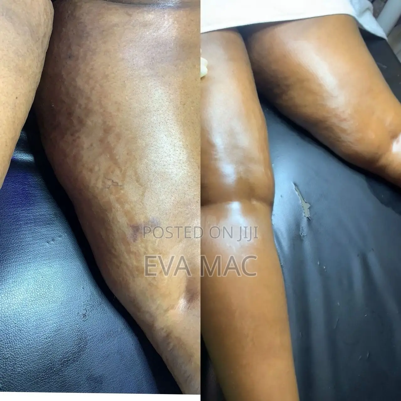 Algae Peel (Herbal Peel)
