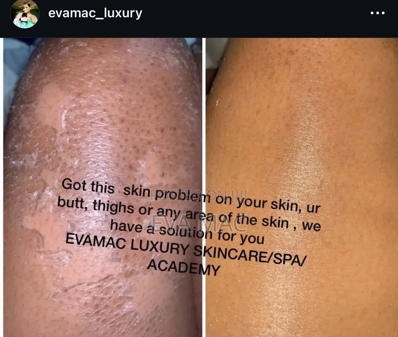 Algae Peel (Herbal Peel)