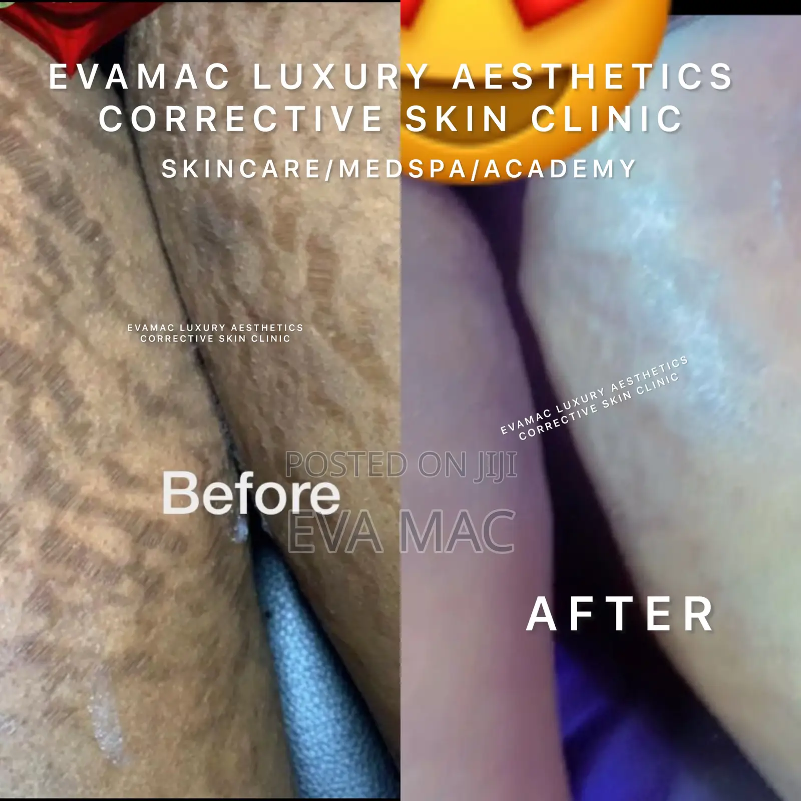 Algae Peel (Herbal Peel)