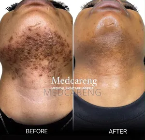 Laser/Permanent Hair Removal