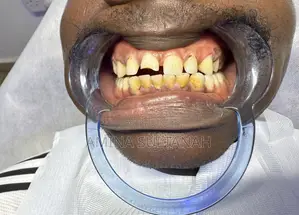 Scaling Polishing