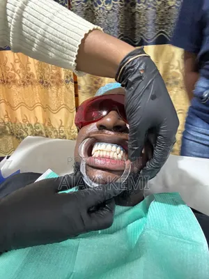 Teeth Whitening Service in Ibadan