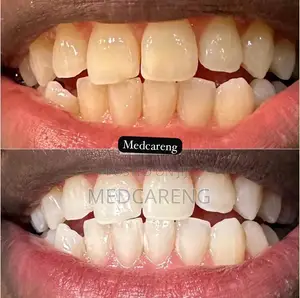 Teeth Whitening Services