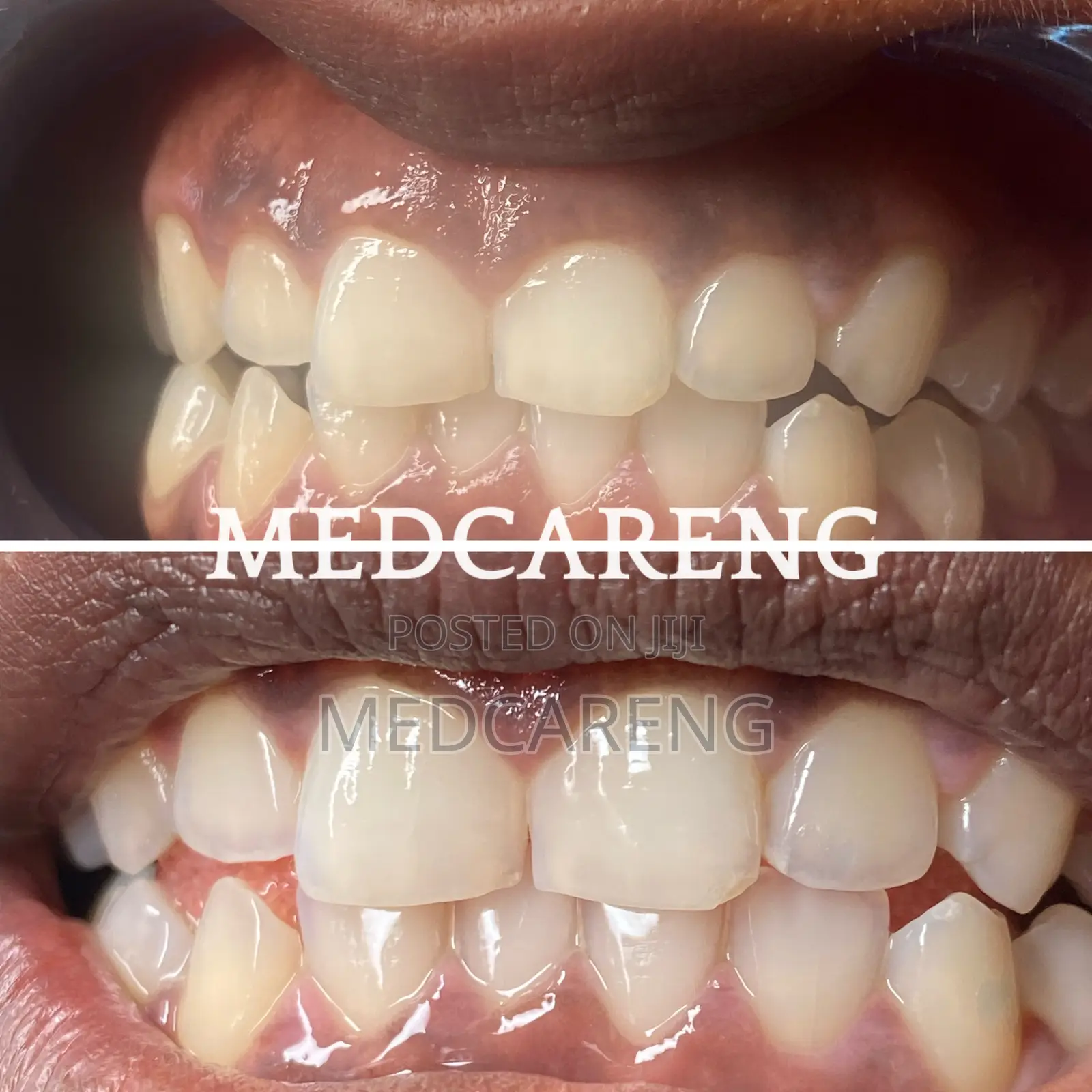Teeth Whitening Services