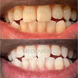 Teeth Whitening Services
