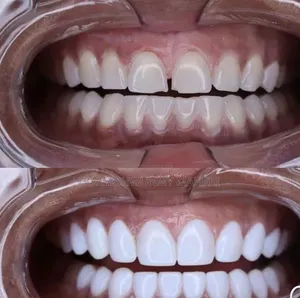 Teeth Veneers