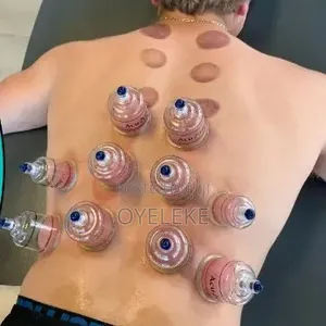 Cupping Therapy