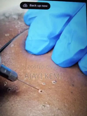Skin Tag Removal Services in Ibadan