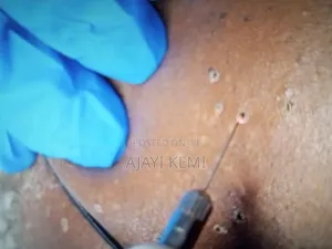 Skin Tag Removal Services in Ibadan
