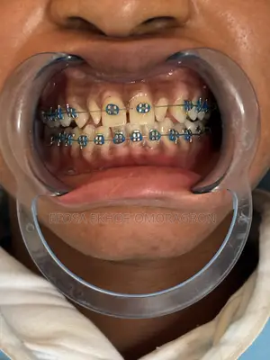 Promo on Dental Treatment