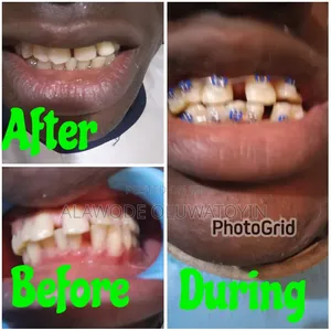 10k Scaling and Polishing,50% Discount Dental Treatment